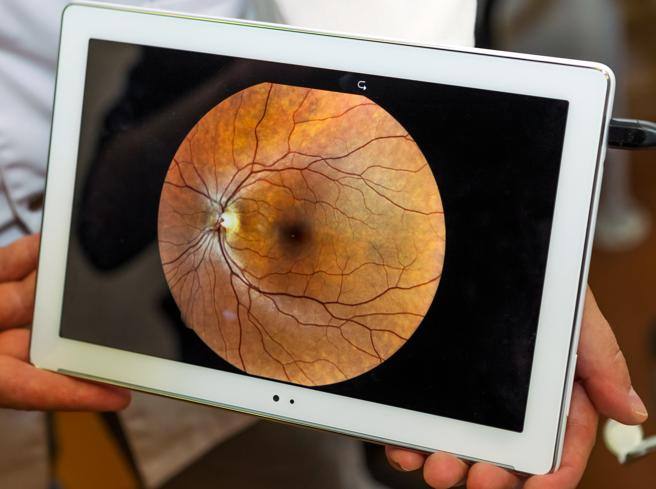 Do you see the “flying flies”? It could be a problem with the retina