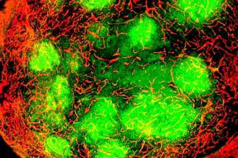 Cancer: new hope for patients with this "cancer killer" virus